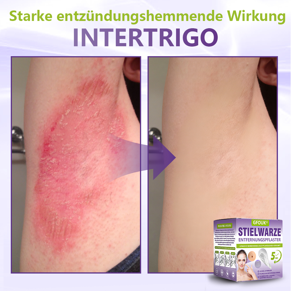 GFOUK® Lösliches Mikronadel-Pflaster zur Entfernung von Hautanhängseln auf Pflanzenbasis🍀🍀🍀