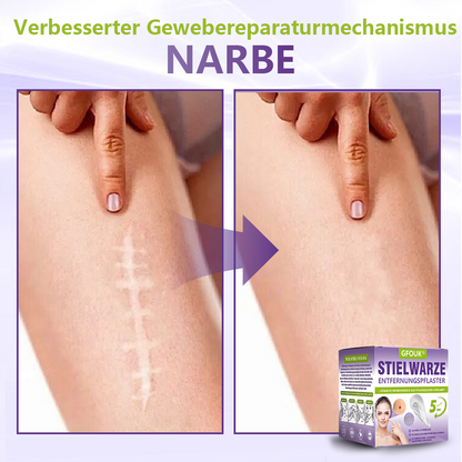 GFOUK® Lösliches Mikronadel-Pflaster zur Entfernung von Hautanhängseln auf Pflanzenbasis🍀🍀🍀