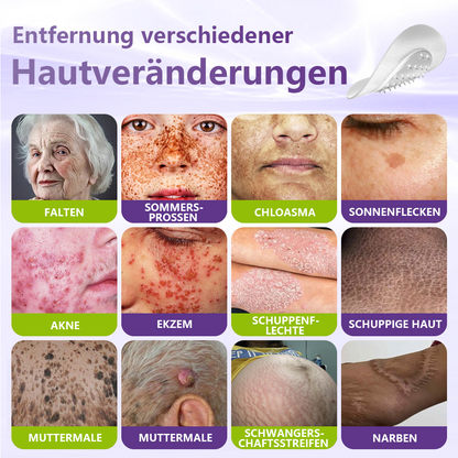 GFOUK® Lösliches Mikronadel-Pflaster zur Entfernung von Hautanhängseln auf Pflanzenbasis🍀🍀🍀