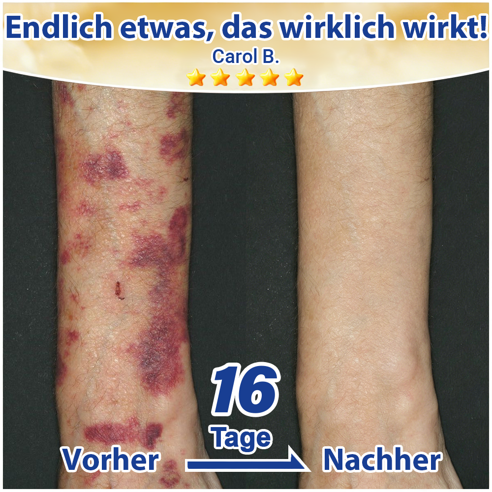 💛 Evolvion® Pflegecreme bei seniler Purpura, Blutergüssen & fragiler Haut -up