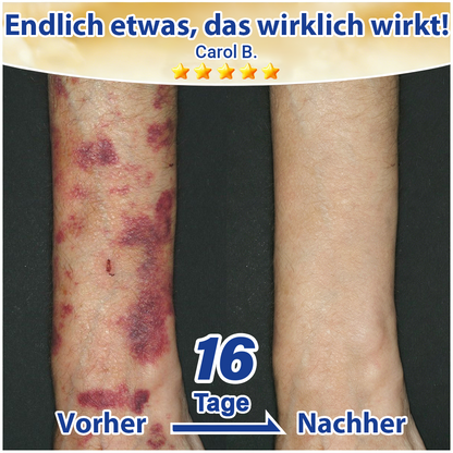 💛 Evolvion® Pflegecreme bei seniler Purpura, Blutergüssen & fragiler Haut -up
