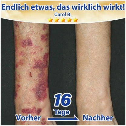 💛💛 Evolvion® Pflegecreme bei seniler Purpura, Blutergüssen & fragiler Haut