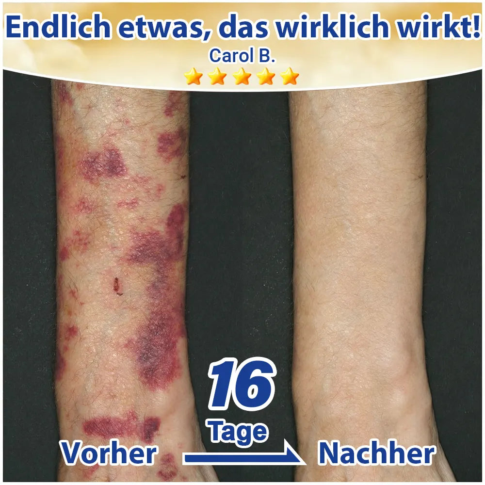 Evolvion® Pflegecreme bei seniler Purpura, Blutergüssen & fragiler Haut 🍇
