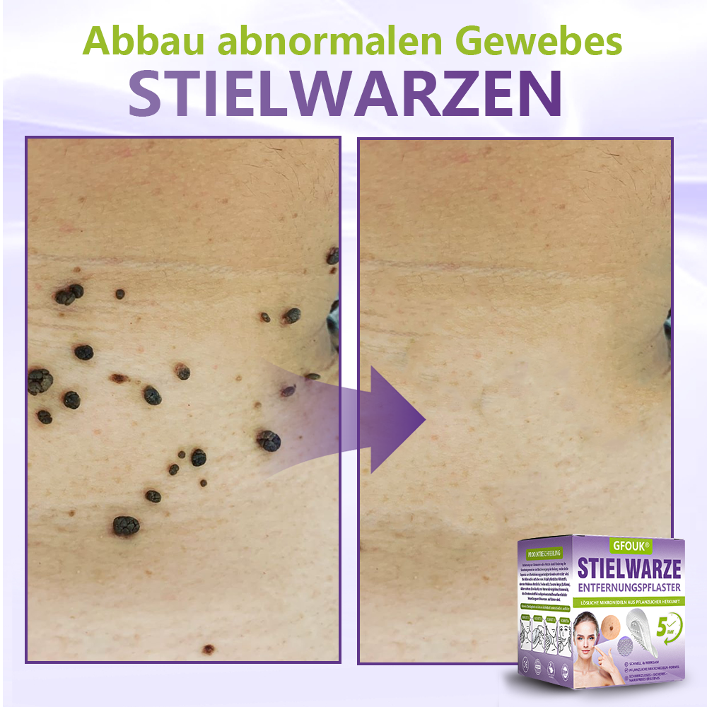 GFOUK® Lösliches Mikronadel-Pflaster zur Entfernung von Hautanhängseln auf Pflanzenbasis🍀🍀🍀