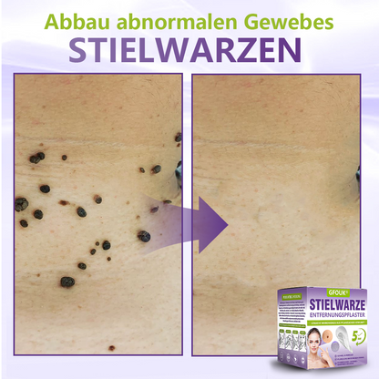 GFOUK® Lösliches Mikronadel-Pflaster zur Entfernung von Hautanhängseln auf Pflanzenbasis🍀🍀🍀