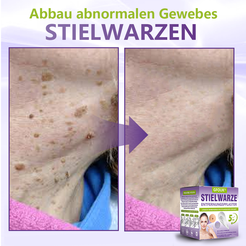 GFOUK® Lösliches Mikronadel-Pflaster zur Entfernung von Hautanhängseln auf Pflanzenbasis🍀🍀🍀