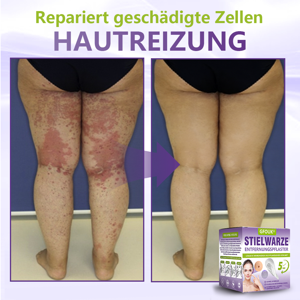 GFOUK® Lösliches Mikronadel-Pflaster zur Entfernung von Hautanhängseln auf Pflanzenbasis🍀🍀🍀