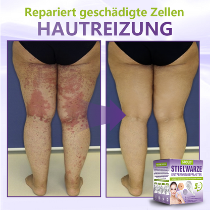 GFOUK® Lösliches Mikronadel-Pflaster zur Entfernung von Hautanhängseln auf Pflanzenbasis🍀🍀🍀