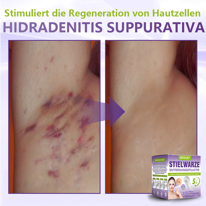 GFOUK® Lösliches Mikronadel-Pflaster zur Entfernung von Hautanhängseln auf Pflanzenbasis🍀🍀🍀