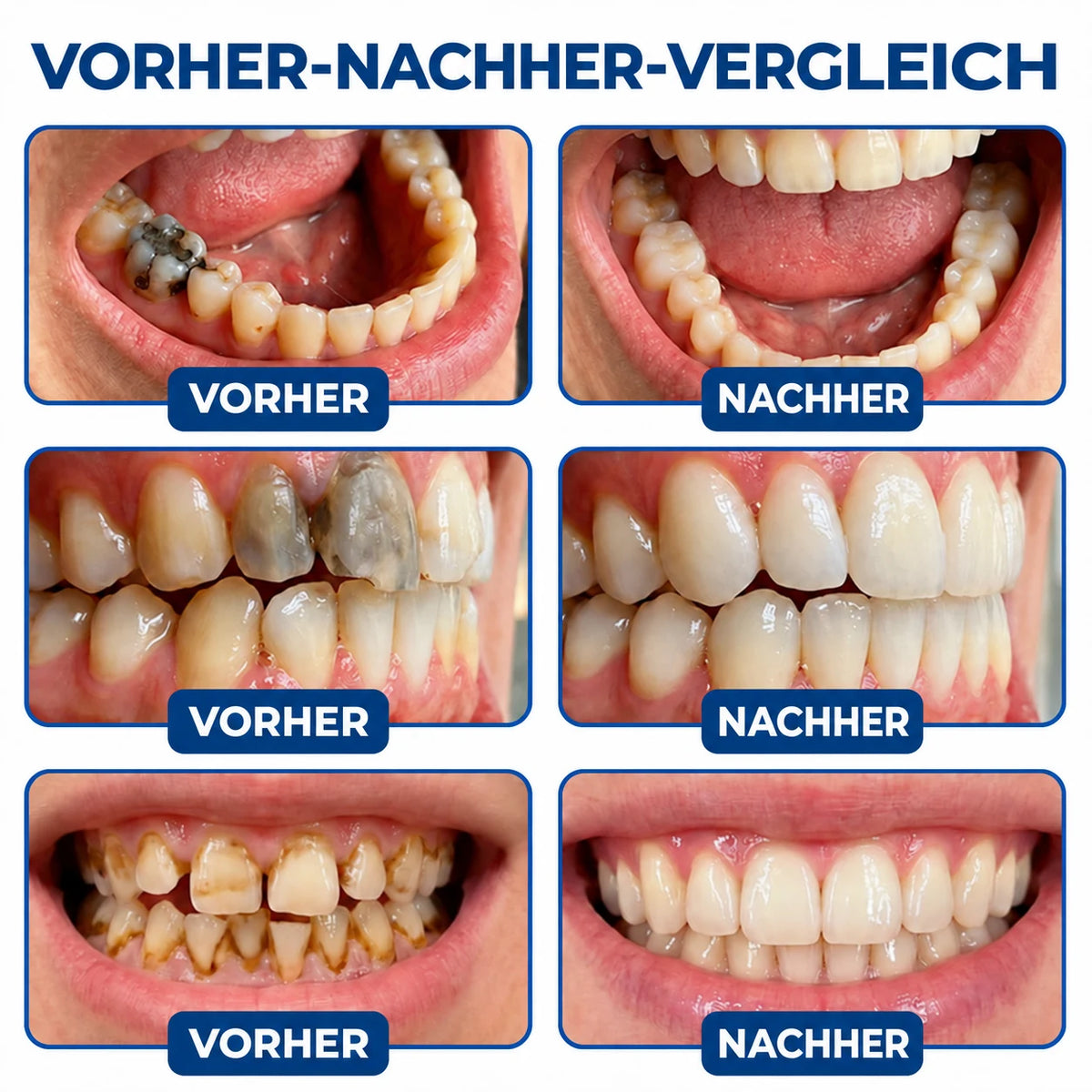 Dr.Fachmer® DentRestore Zahnreparatur- und Füllsystem 🌷