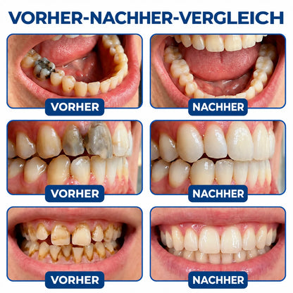Dr.Fachmer® DentRestore Zahnreparatur- und Füllsystem 🌷