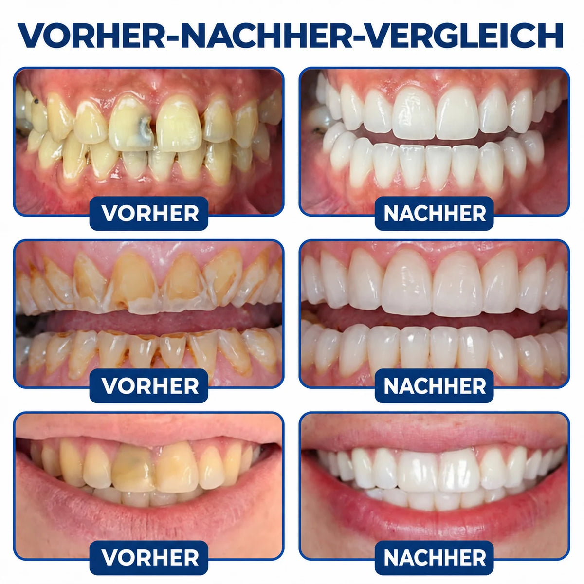 Dr.Fachmer® DentRestore Zahnreparatur- und Füllsystem 🌷